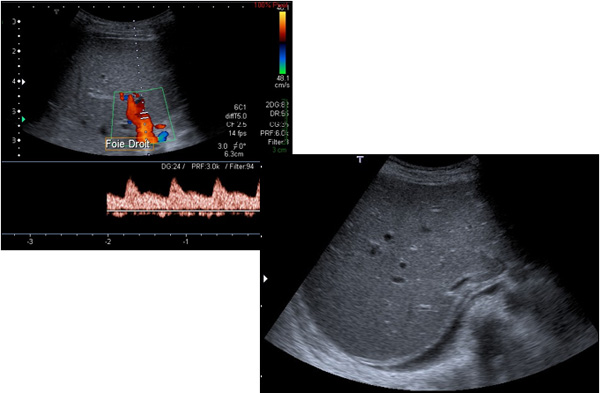 Echographie obstétricale : Définition et déroulement