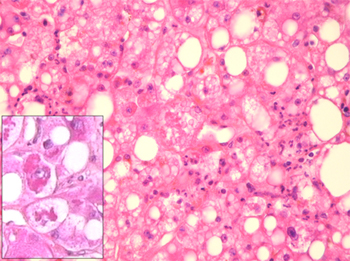 Photographie macroscopique d'une biopsie montrant une stéatohépatite non alcoolique