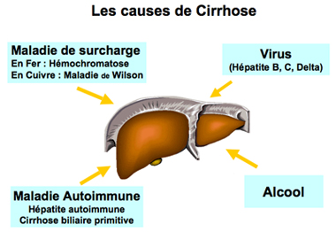 Fibrose et Cirrhose Hépatique | Centre Hépato-Biliaire Paul Brousse