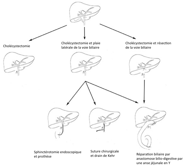 Schema-reparation-biliaire-Professeur-Castaing